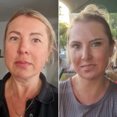 Facelift
