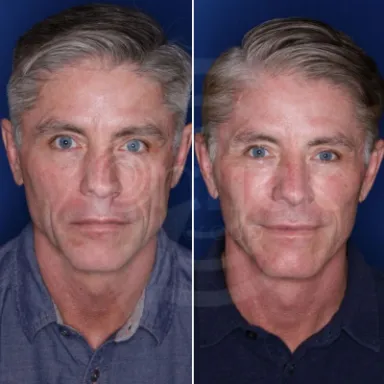 Facelift