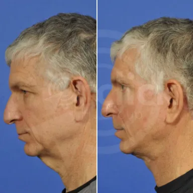 Facelift