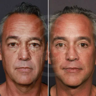 Facelift