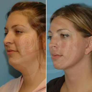 Facelift