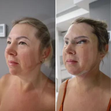 Facelift