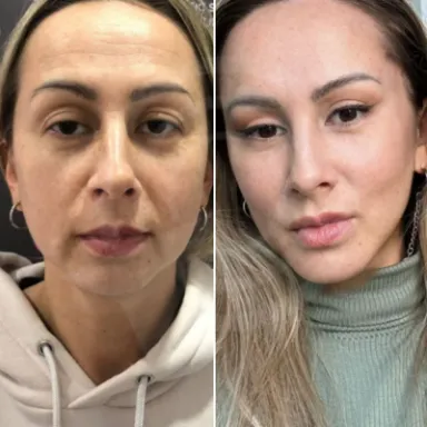 Facelift
