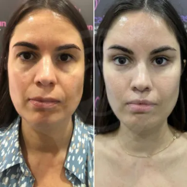 Facelift