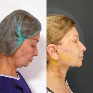 Facelift