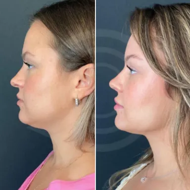 Facelift