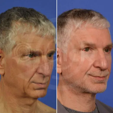 Facelift