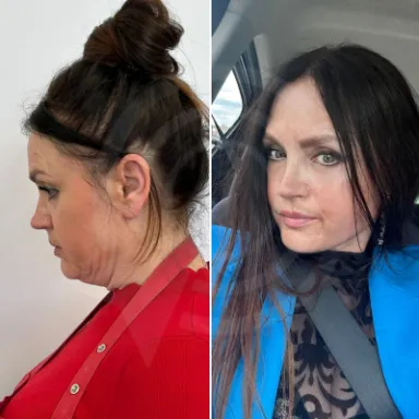 Facelift