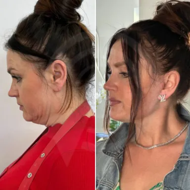 Facelift