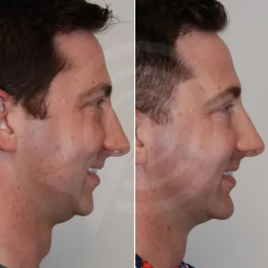 Facelift