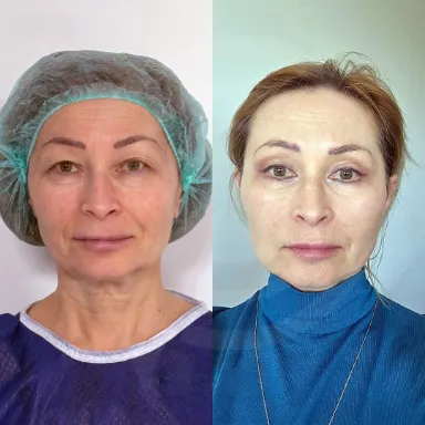 Facelift
