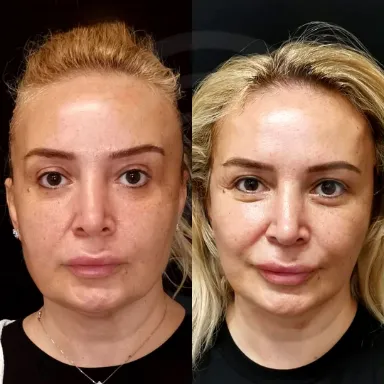 Facelift