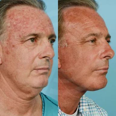 Facelift