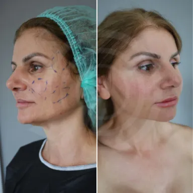 Facelift
