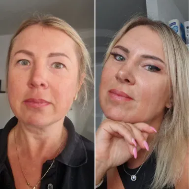 Facelift