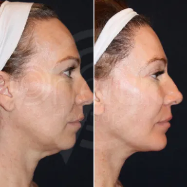 Facelift
