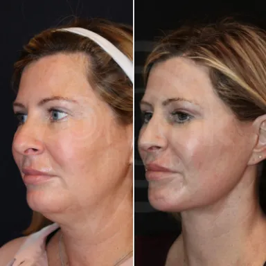 Facelift