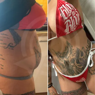 Liposuction