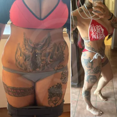Liposuction