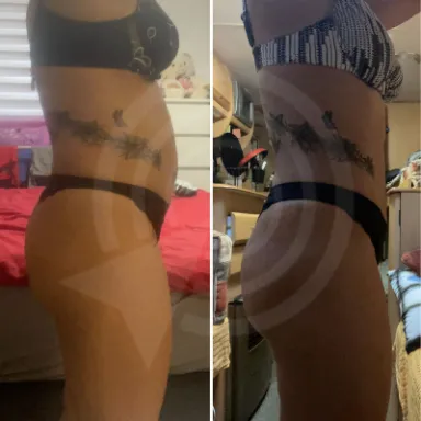 Liposuction