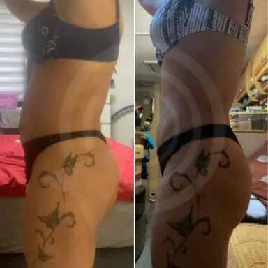 Liposuction
