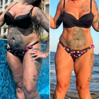 Liposuction