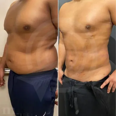 Liposuction