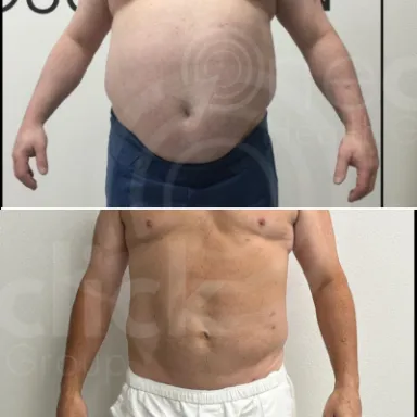 Liposuction
