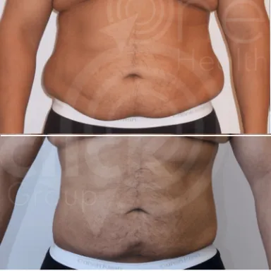 Liposuction