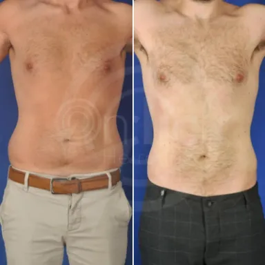 Liposuction