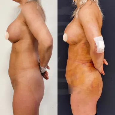 Liposuction