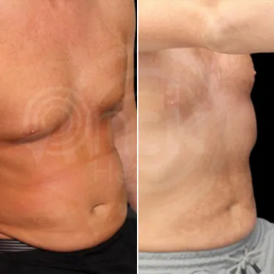 Liposuction