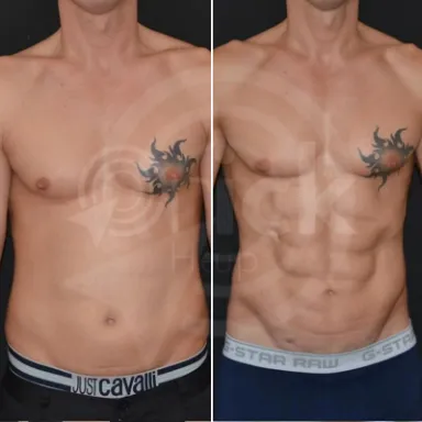 Liposuction