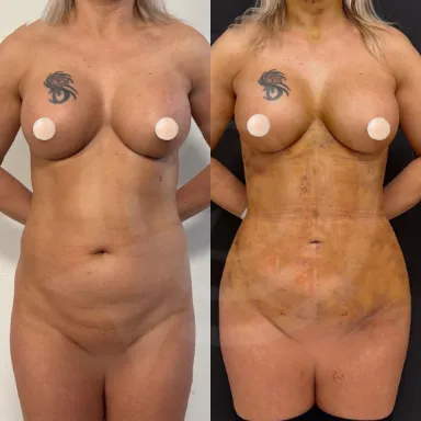 Liposuction