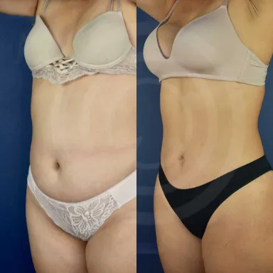 Liposuction