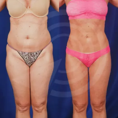 Liposuction