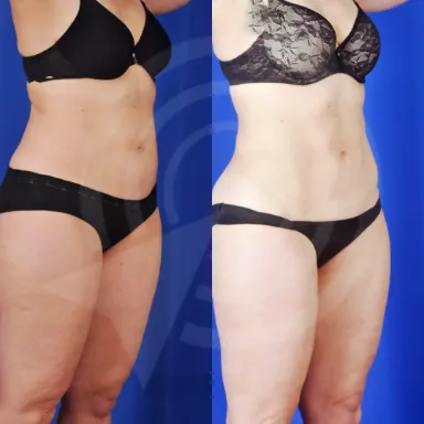 Liposuction