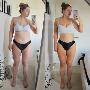 Liposuction