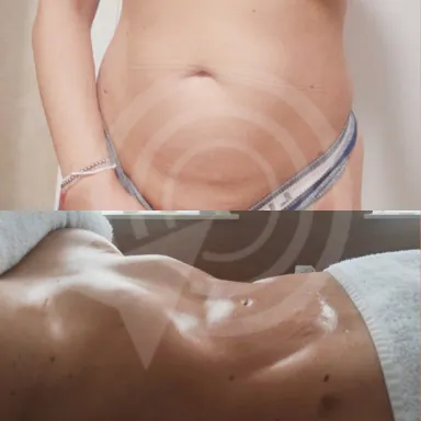 Liposuction