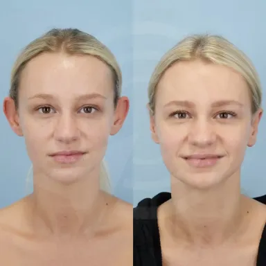 Otoplasty