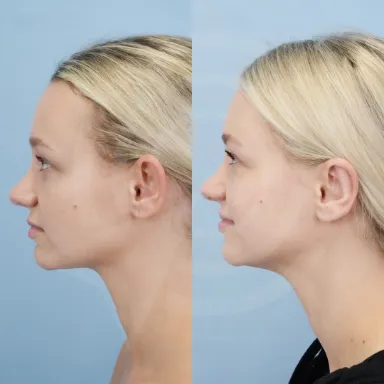 Otoplasty