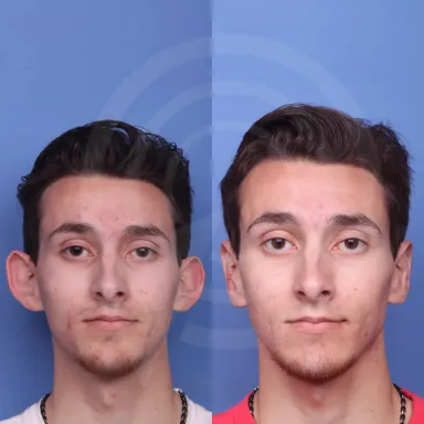 Otoplasty