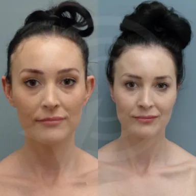 Otoplasty