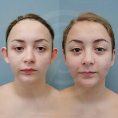 Otoplasty