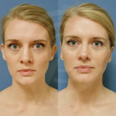 Otoplasty