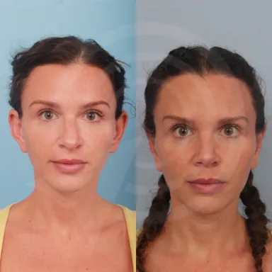 Otoplasty