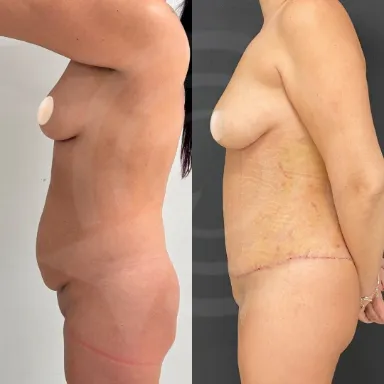 Tummy Tuck