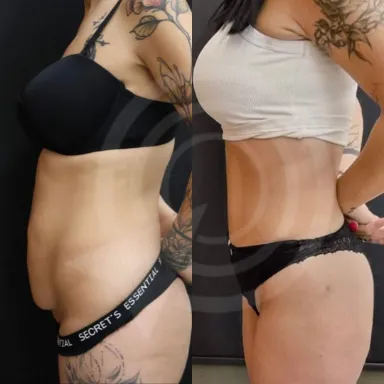 Tummy Tuck