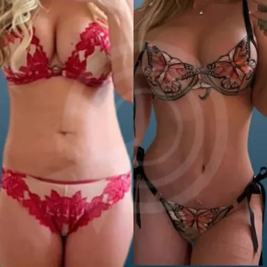 Tummy Tuck