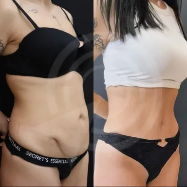 Tummy Tuck